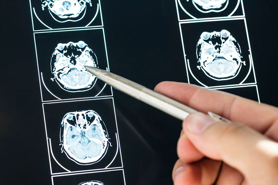 Lack of physical activity is linked to faster cognitive decline
